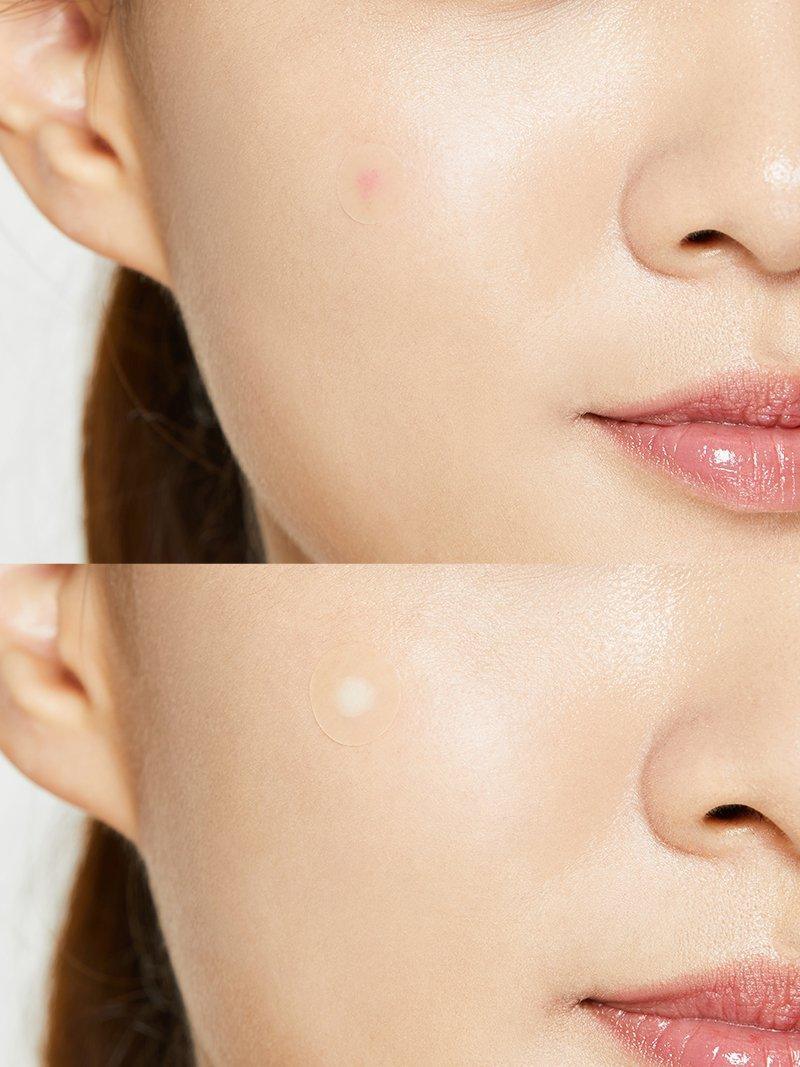 Acne Pimple Master Patch - 10 pcs