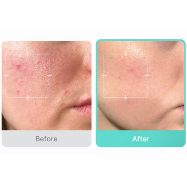Azelaic Acid 16 BB Soothing Serum - 30ml